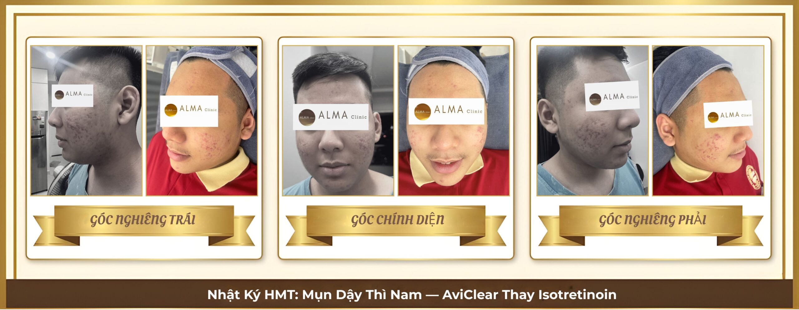 3 review aviclear mun day thi hmt scaled Ca lâm sàng HMT — mụn sẩn mủ dậy thì nam giới mật độ cao, chống chỉ định Isotretinoin. 3 buổi AviClear 1726nm kiểm soát tuyến bã nhờn, ngăn sẹo rỗ. Ảnh 3 góc tuần tự.