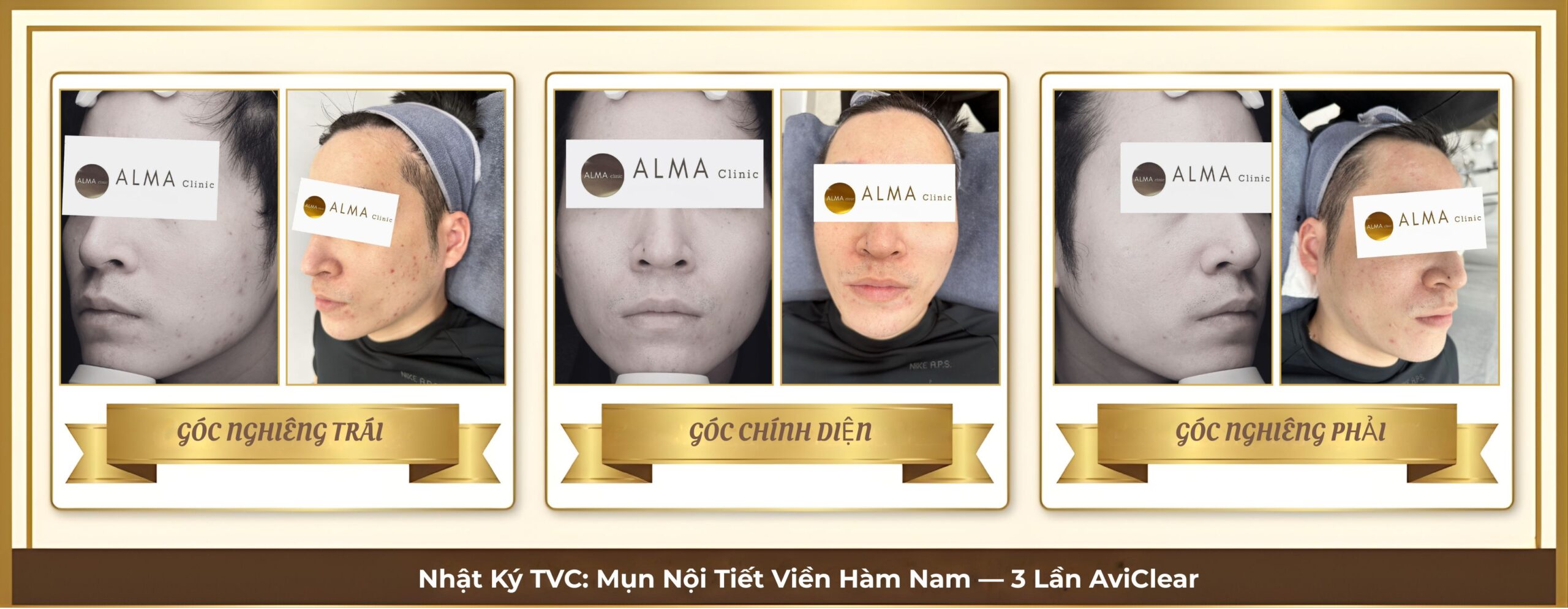 4 review aviclear mun noi tiet tvc scaled Ca lâm sàng TVC — mụn sẩn đỏ nội tiết vùng U-zone (cằm, viền hàm) tái phát dù đã dùng nhiều đợt kháng sinh. 3 buổi AviClear 1726nm không dùng thuốc uống. Ảnh 3 góc tuần tự.