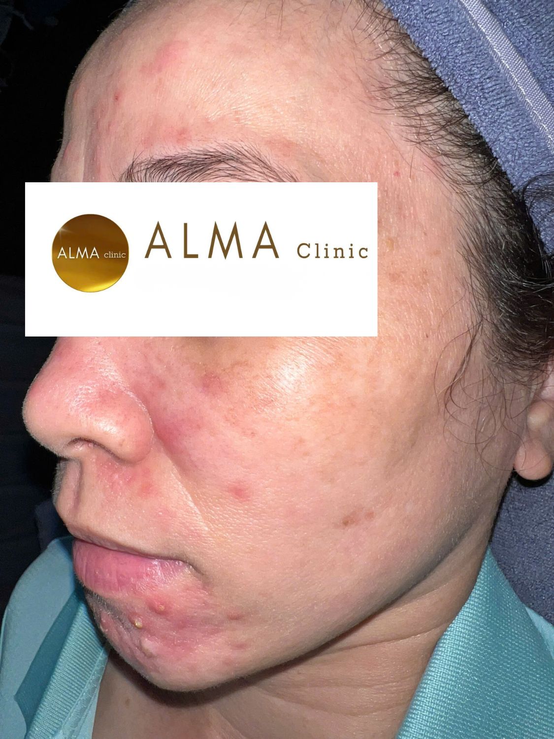 goc nghieng trai viem nang ham trai cam not viem sau do truoc aviclear case 06 VTKO