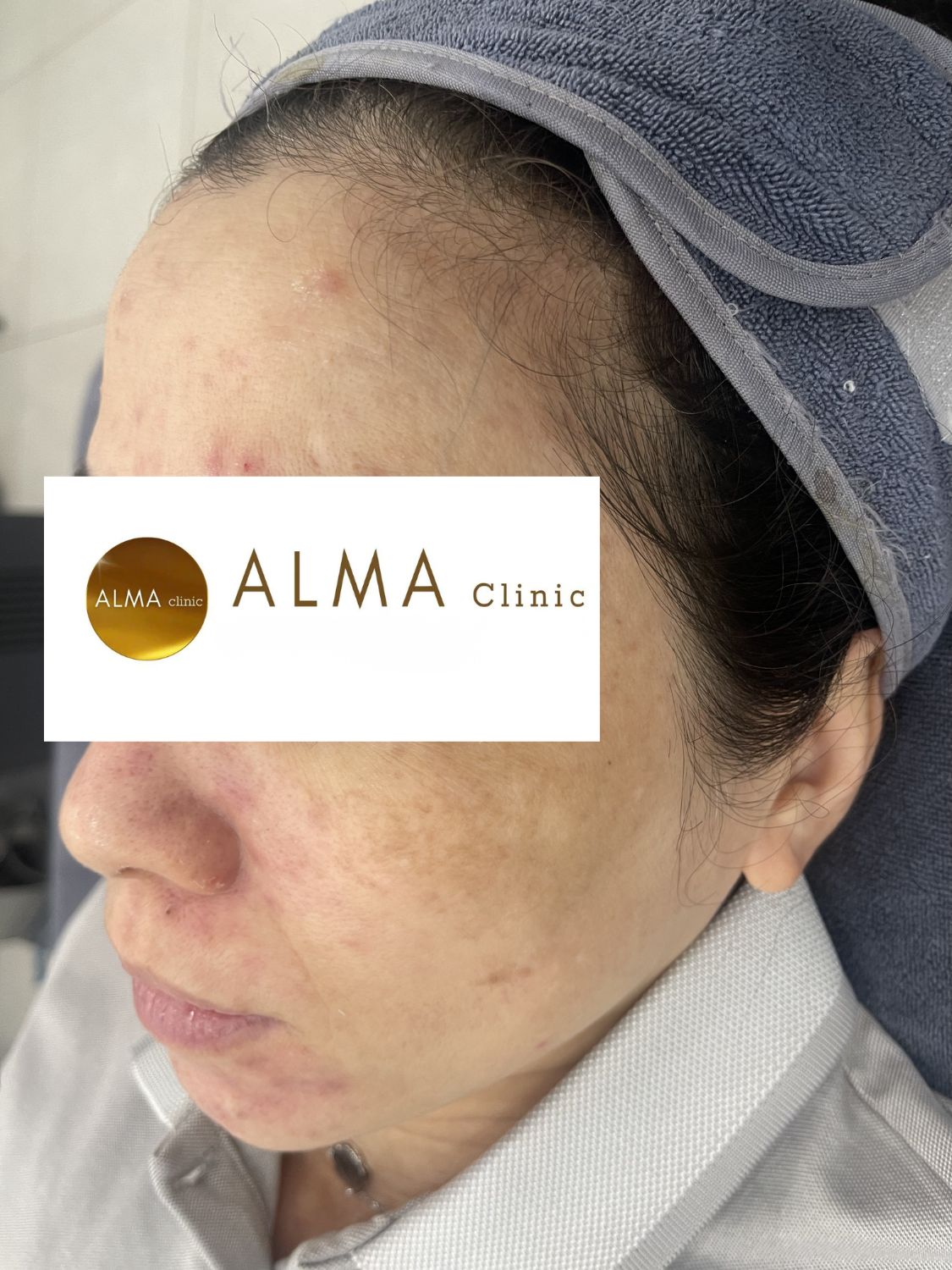 goc nghieng trai giam not viem sau lon ban do sau viem chua cai thien dang ke case 06 VTKO