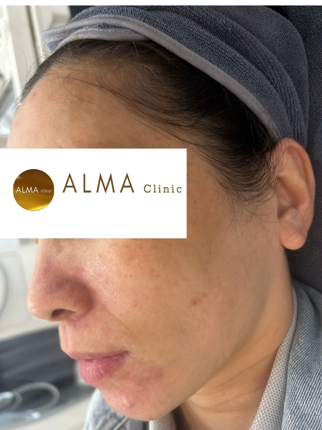 goc nghieng trai ket qua lan 3 tham nau hinh thanh ro ma trai con not san viem nho case 06 VTKO