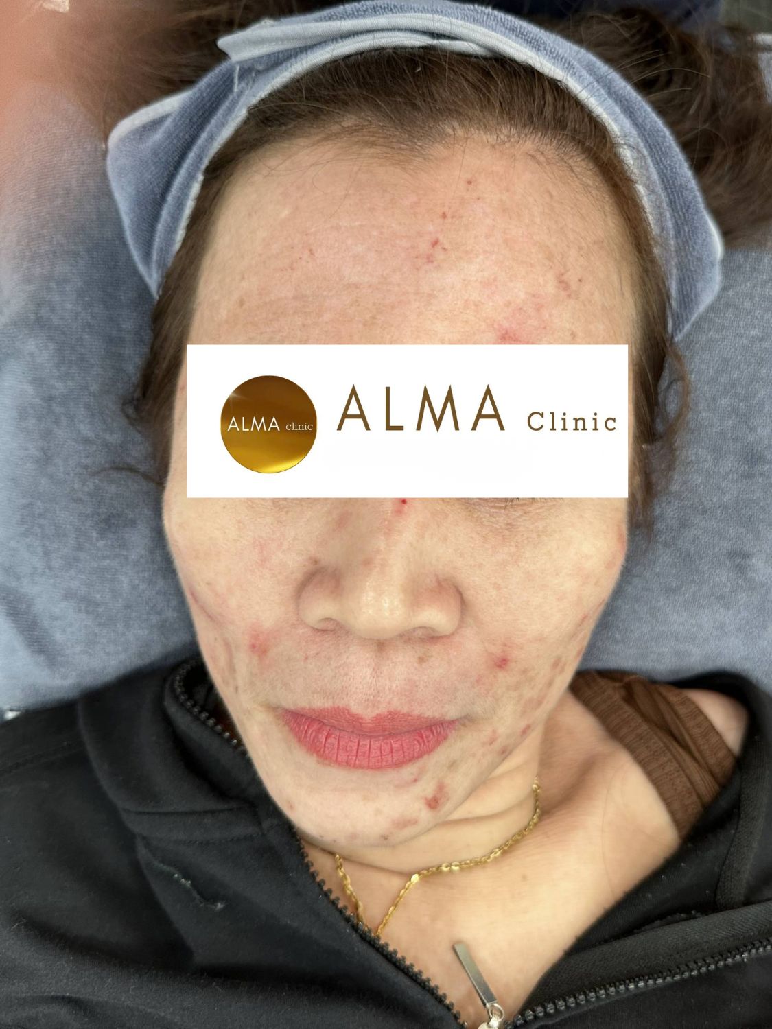 Benh nhan NTNH AviClear lan 1 goc chinh dien mun viem hai ben ma cam nen PIE do hong