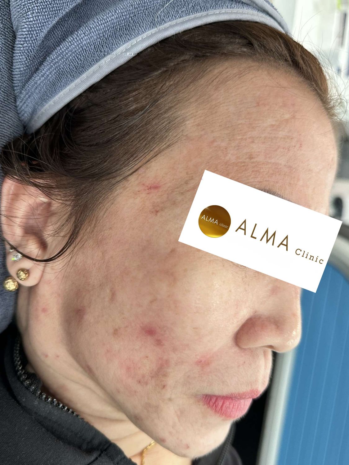 CASE 02 GOC NP TEN NTNH LAN 1 NGAY 251030 1 Benh nhan NTNH AviClear lan 1 goc nghieng phai o viem go ro ma phai cam nen do lan toa