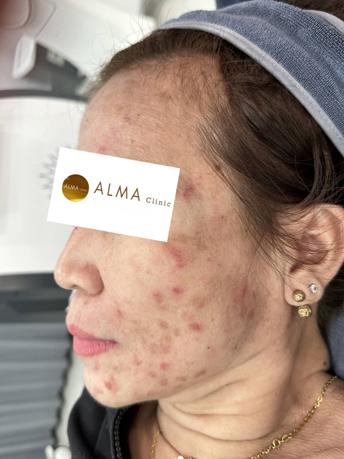 CASE 02 GOC NT TEN NTNH LAN 1 NGAY 251030 Benh nhan NTNH AviClear lan 1 goc nghieng trai mun viem ma trai va co mat do cao