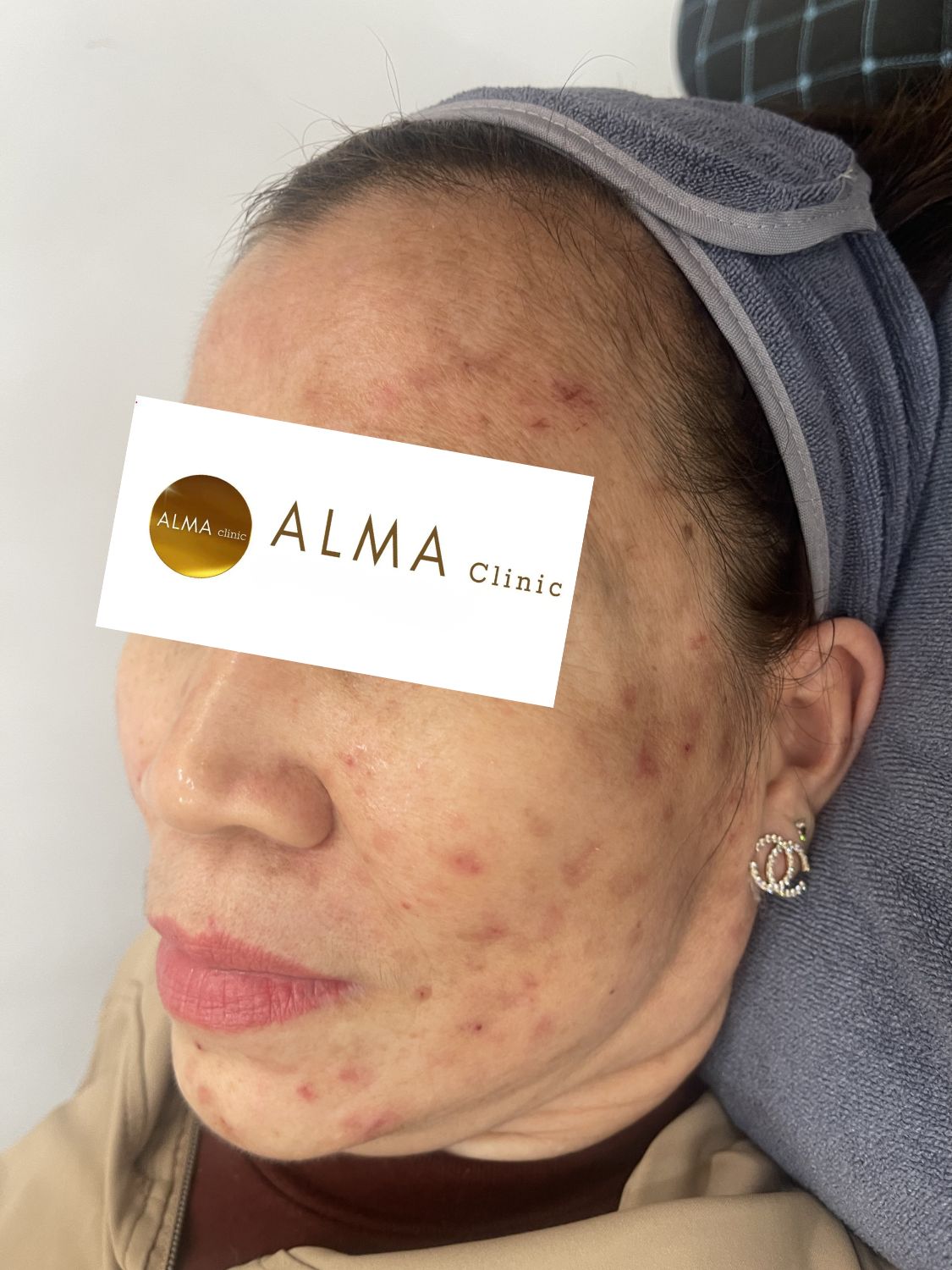 CASE 02 GOC NT TEN NTNH LAN 2 NGAY 251129 Benh nhan NTNH AviClear lan 2 goc nghieng trai ma trai cai thien som cam con o viem nho