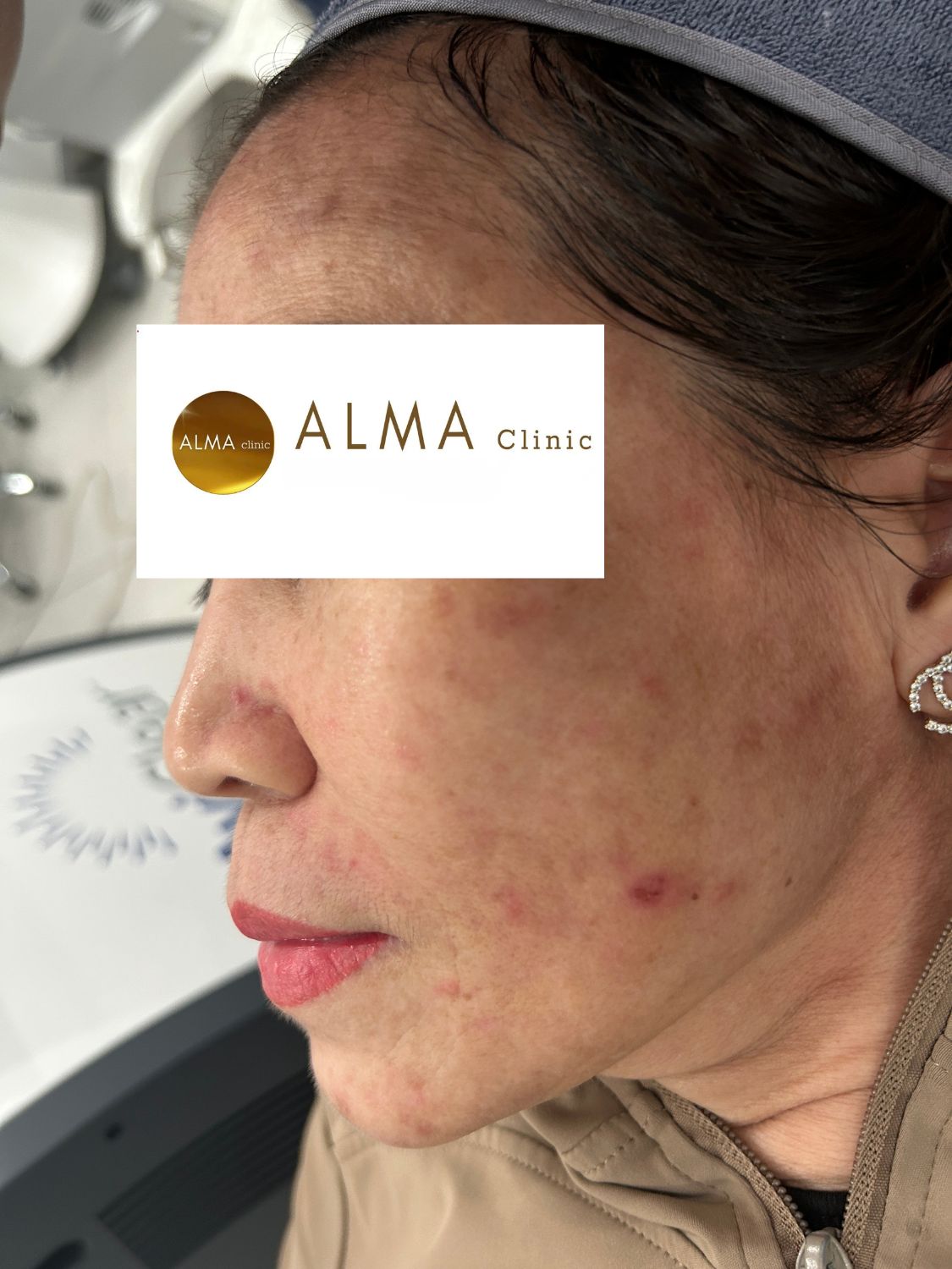 CASE 02 GOC NT TEN NTNH LAN 3 NGAY 260104 benh nhan ntnh aviclear lan 3 nghieng trai be mat giam san sui vet do pie va tham pih hien dien ro