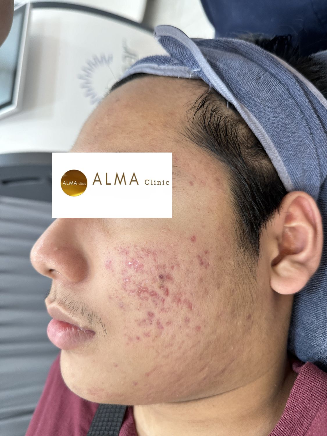 Phòng khám da liễu ALMA CLINIC CASE 03 GOC NT TEN HMT lan 2 NGAY 251011