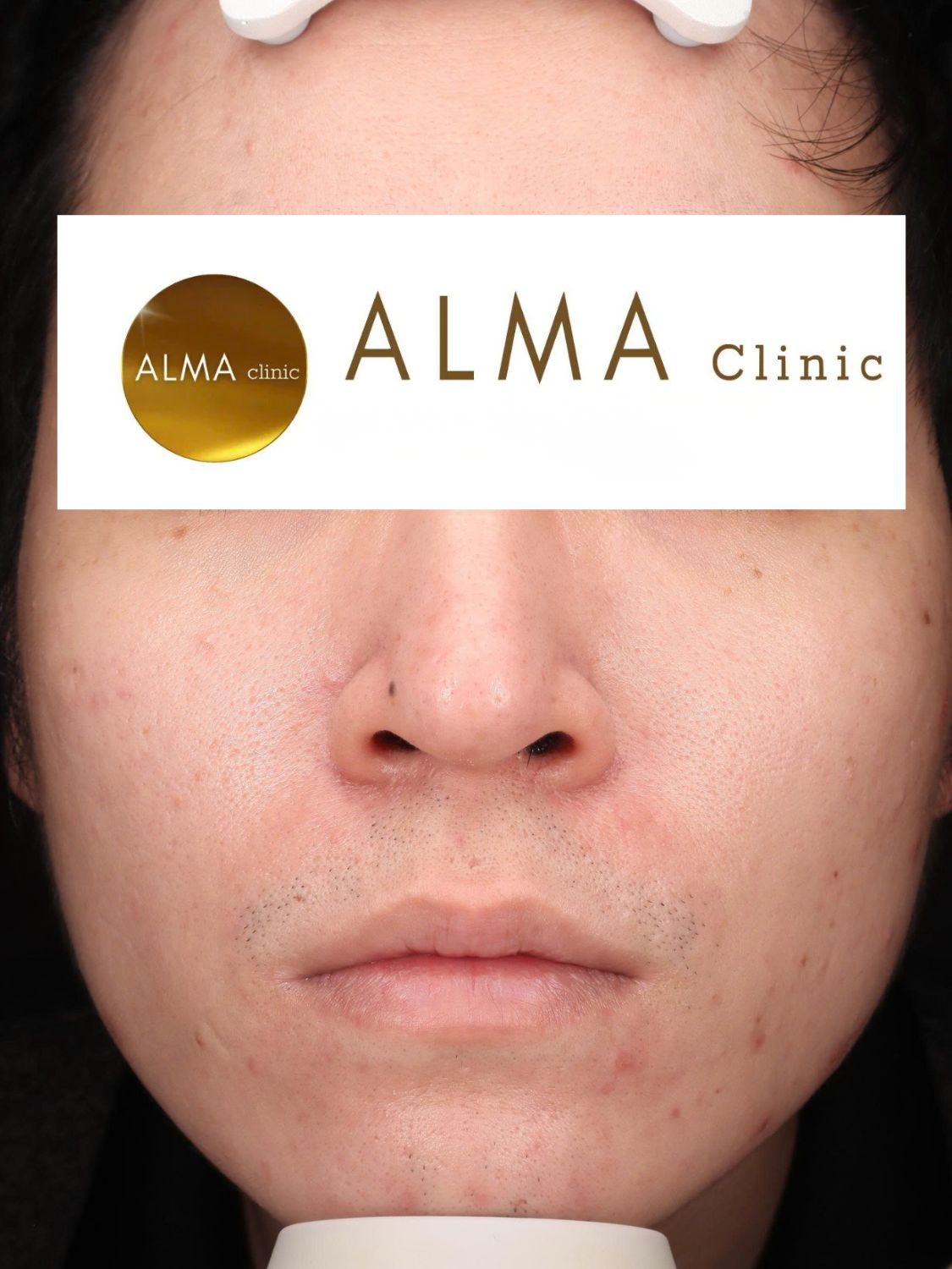 Phòng khám da liễu ALMA CLINIC CASE 04 GOC CD VISTA TEN TVC lan 1 NGAY 251006