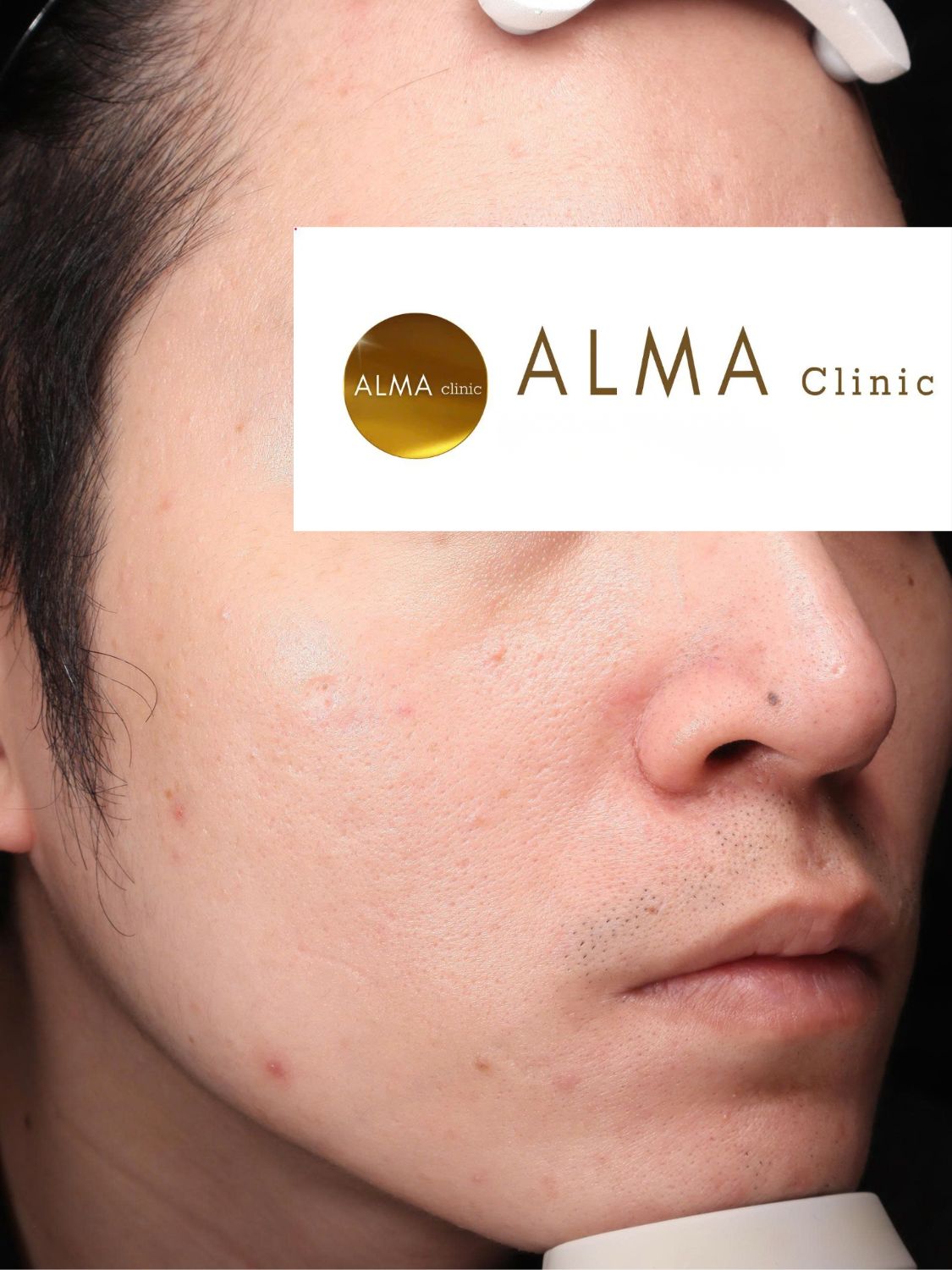 Phòng khám da liễu ALMA CLINIC CASE 04 GOC NP VISTA TEN TVC lan 1 NGAY 251006