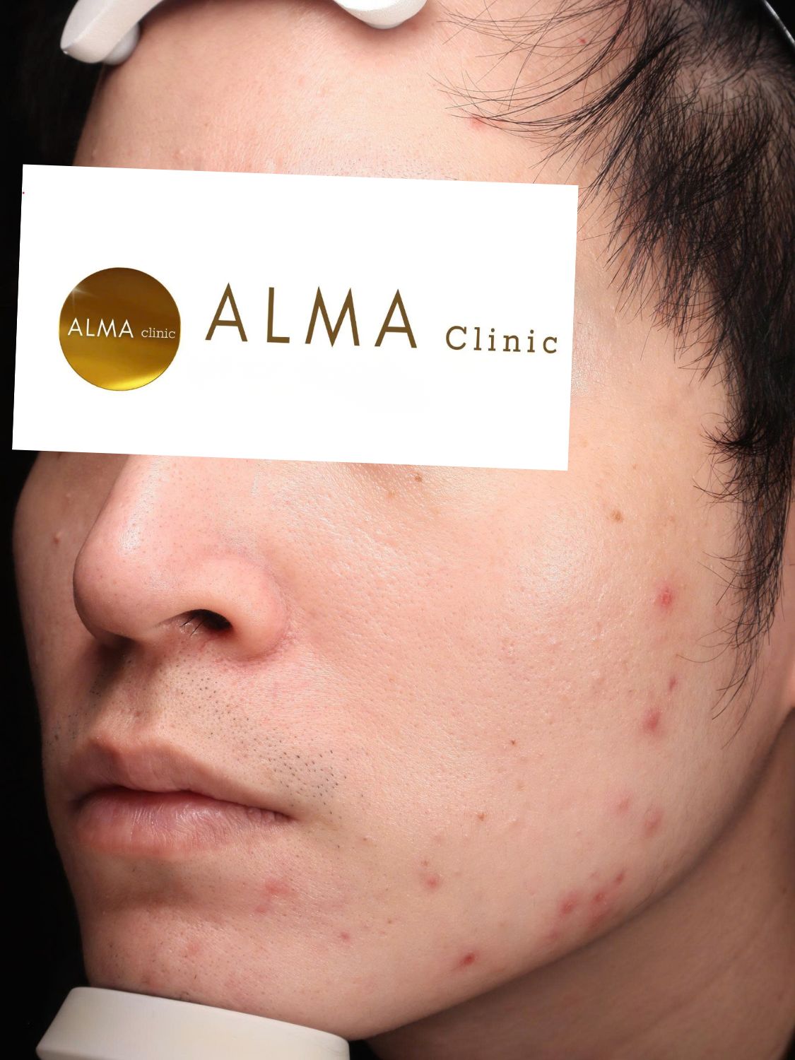 Phòng khám da liễu ALMA CLINIC CASE 04 GOC NT VISTA TEN TVC lan 1 NGAY 251006