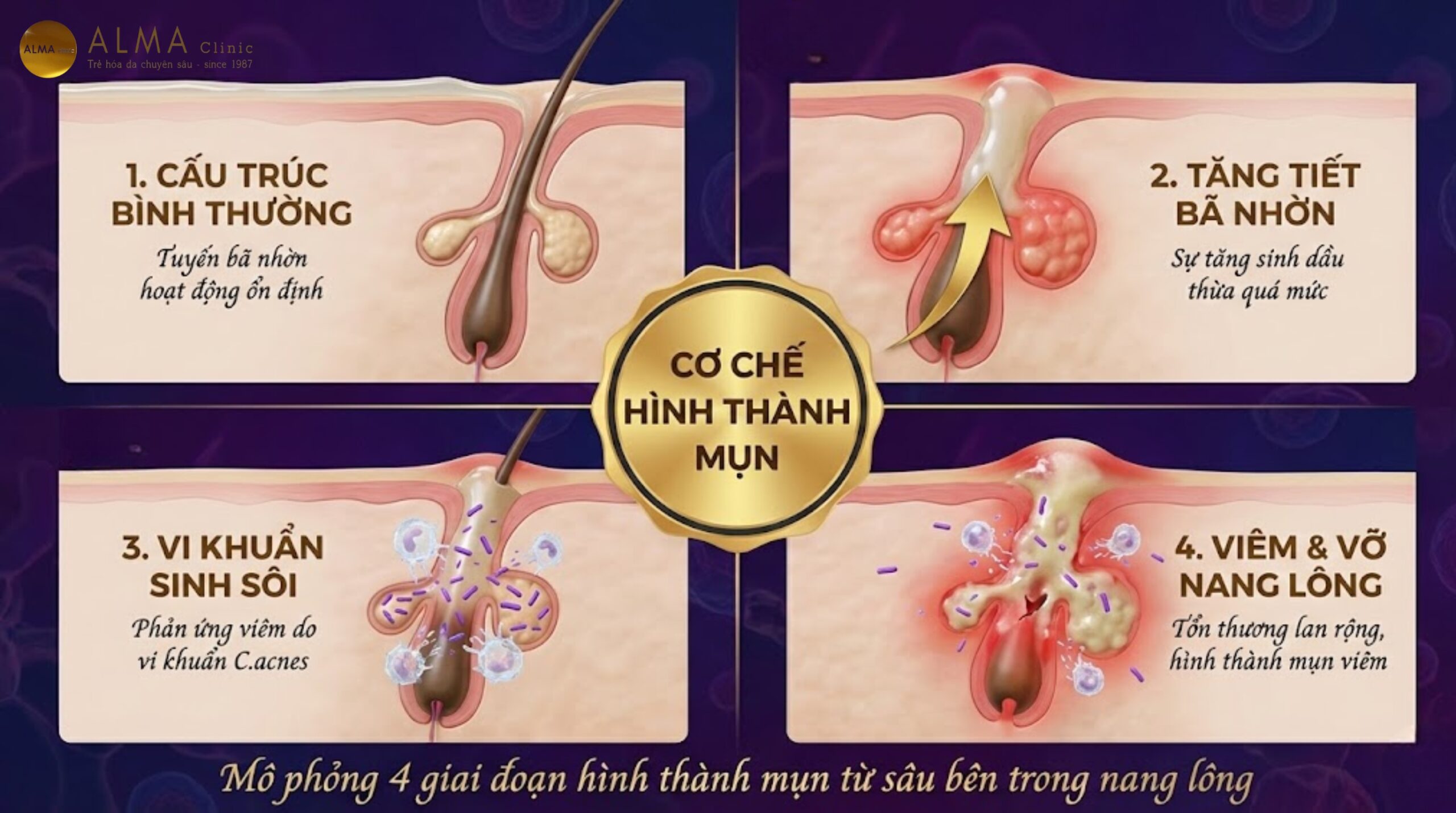 Cơ chế hình thành mụn trứng cá từ tuyến bã nhờn và vi khuẩn C.acnes