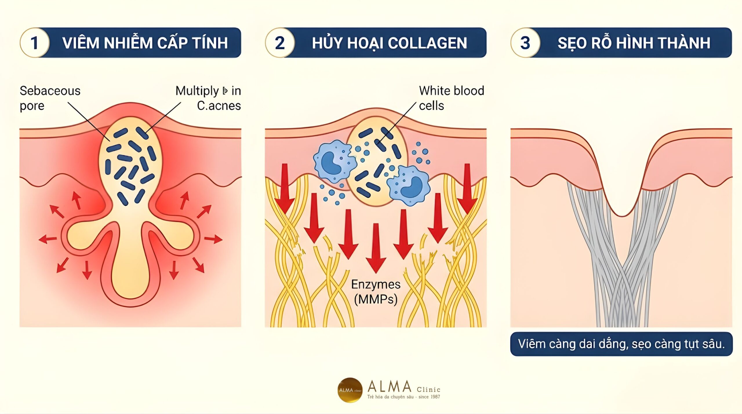 Quá trình hình thành sẹo rỗ do mụn bọc sưng nặn sai cách ở da. Enzyme phá vỡ liên kết collagen để lại vết lõm rỗ vĩnh viễn.