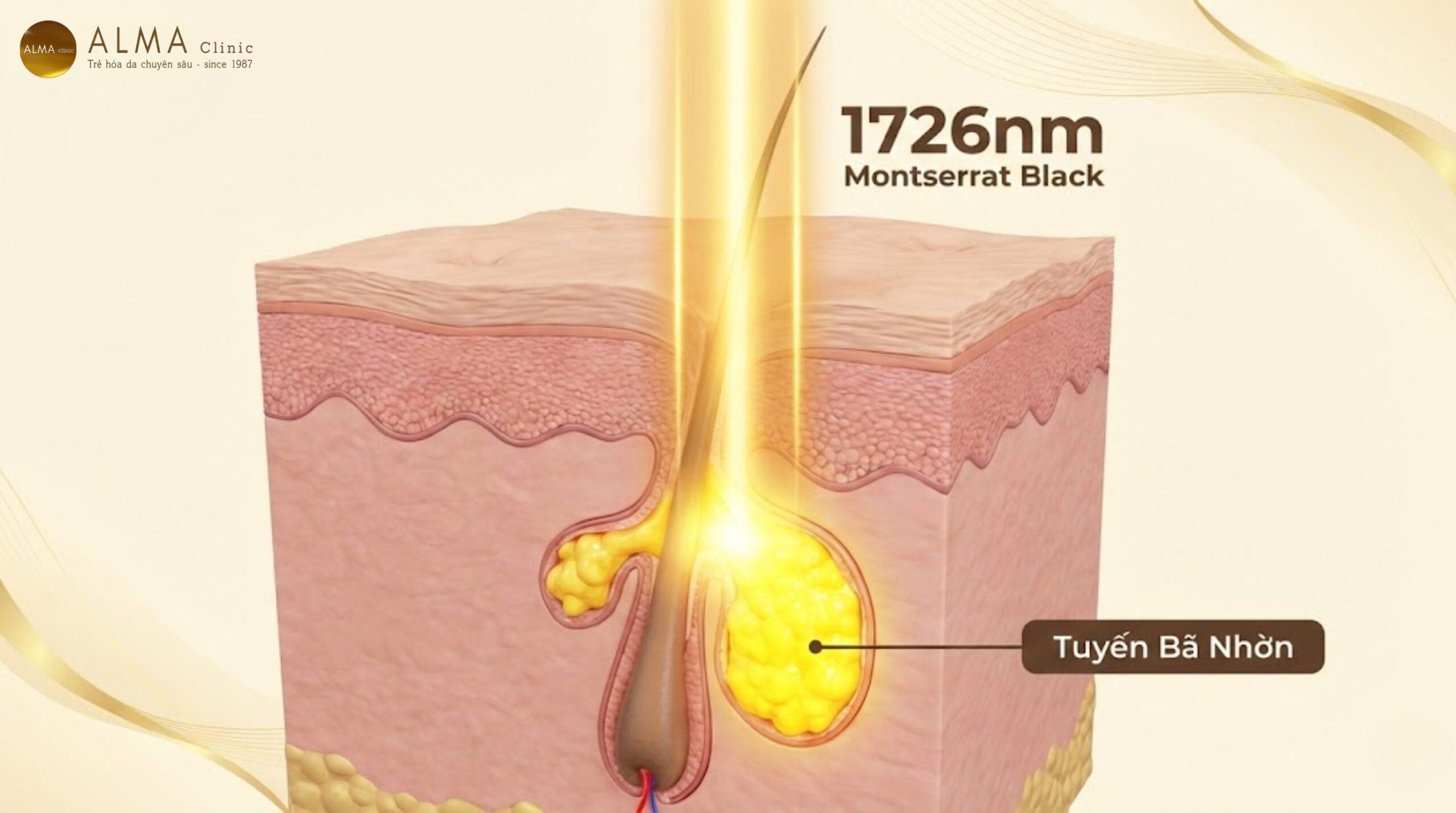 co che laser aviclear triet tieu tuyen ba nhon scaled Cơ chế laser 1726nm của AviClear tác động chọn lọc vào tuyến bã nhờn - hình ảnh y khoa 3D