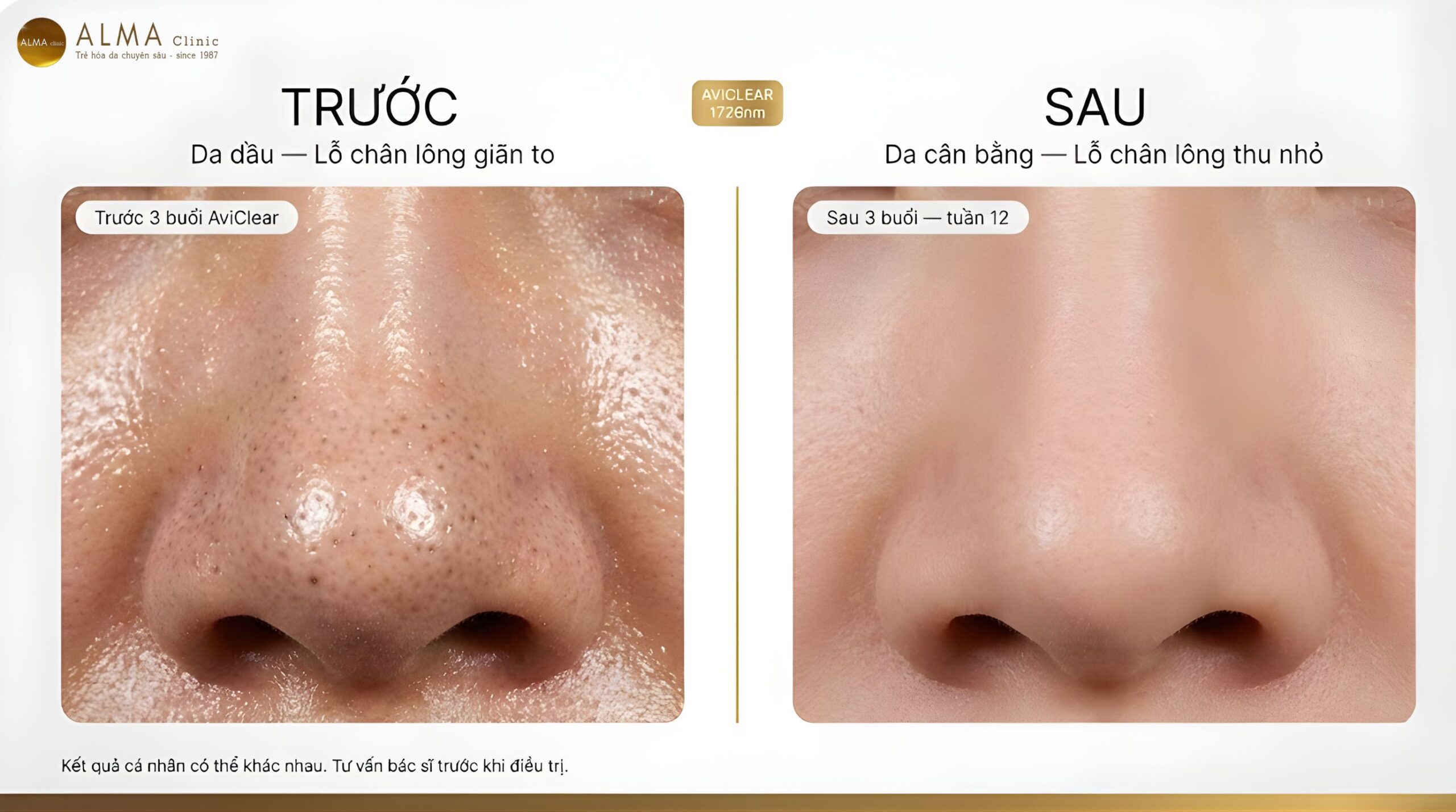 Kết quả kiềm dầu và thu nhỏ lỗ chân lông trước và sau điều trị AviClear tại Alma Clinic — da mịn, lỗ chân lông nhỏ rõ rệt sau 3 buổi