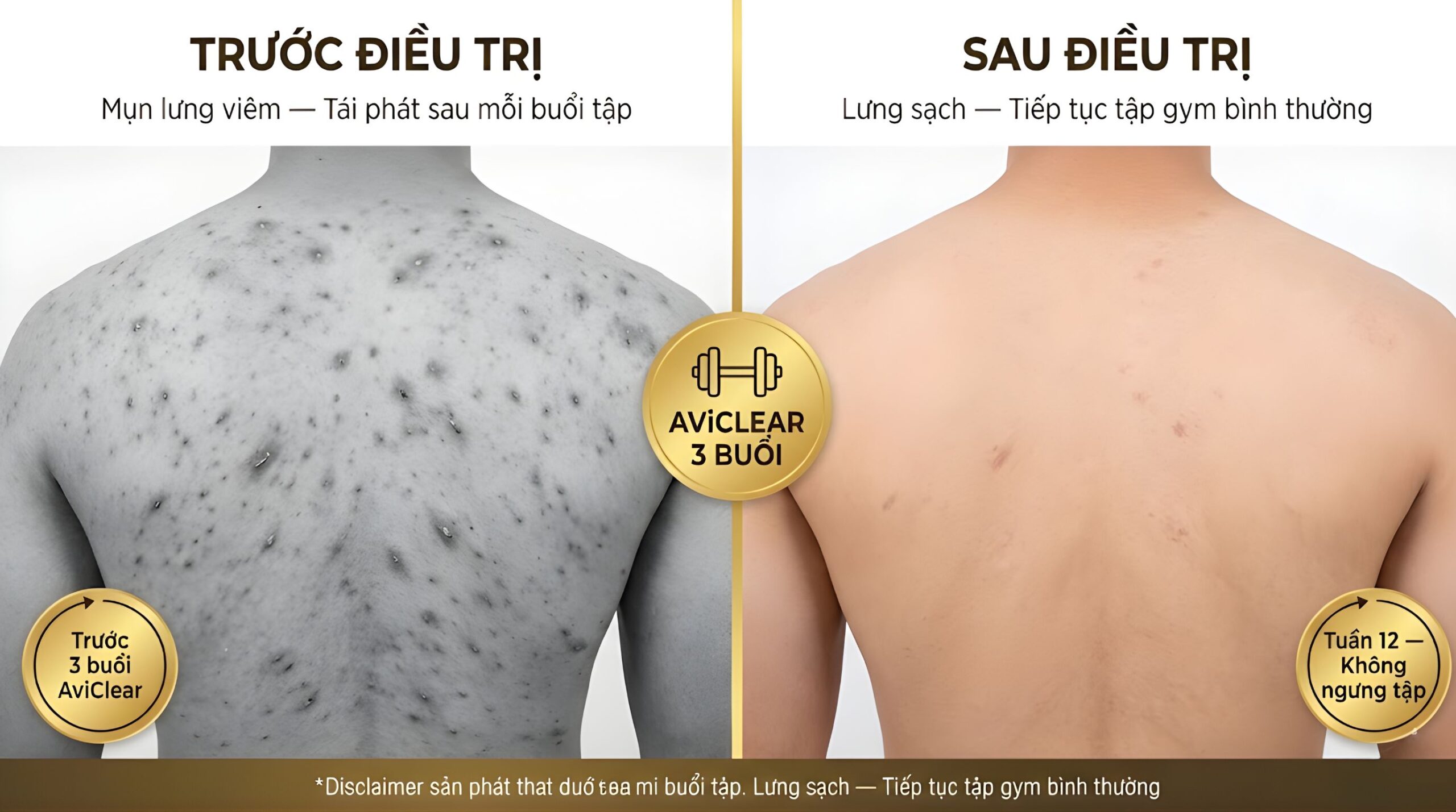 ket qua tri mun lung aviclear truoc sau alma scaled Kết quả trị mụn lưng và ngực bằng AviClear tại Alma Clinic — trước và sau 3 buổi: lưng sạch mụn rõ rệt, bệnh nhân tiếp tục tập gym không cần ngưng, kết quả duy trì bền vững