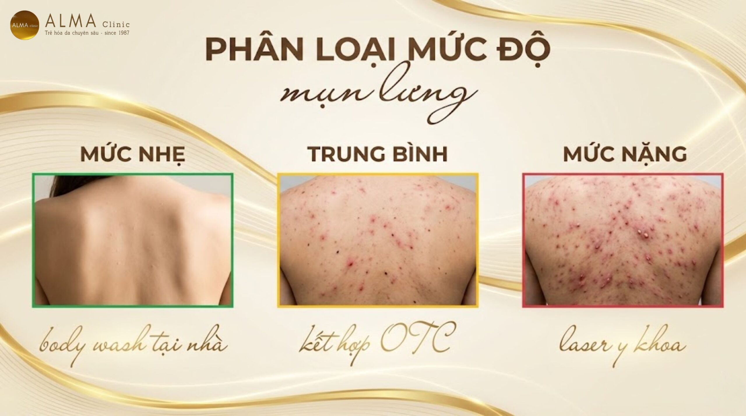 Phân loại mụn lưng theo mức độ nặng nhẹ - mụn nhẹ trung bình nặng và phương pháp điều trị phù hợp - hướng dẫn Alma