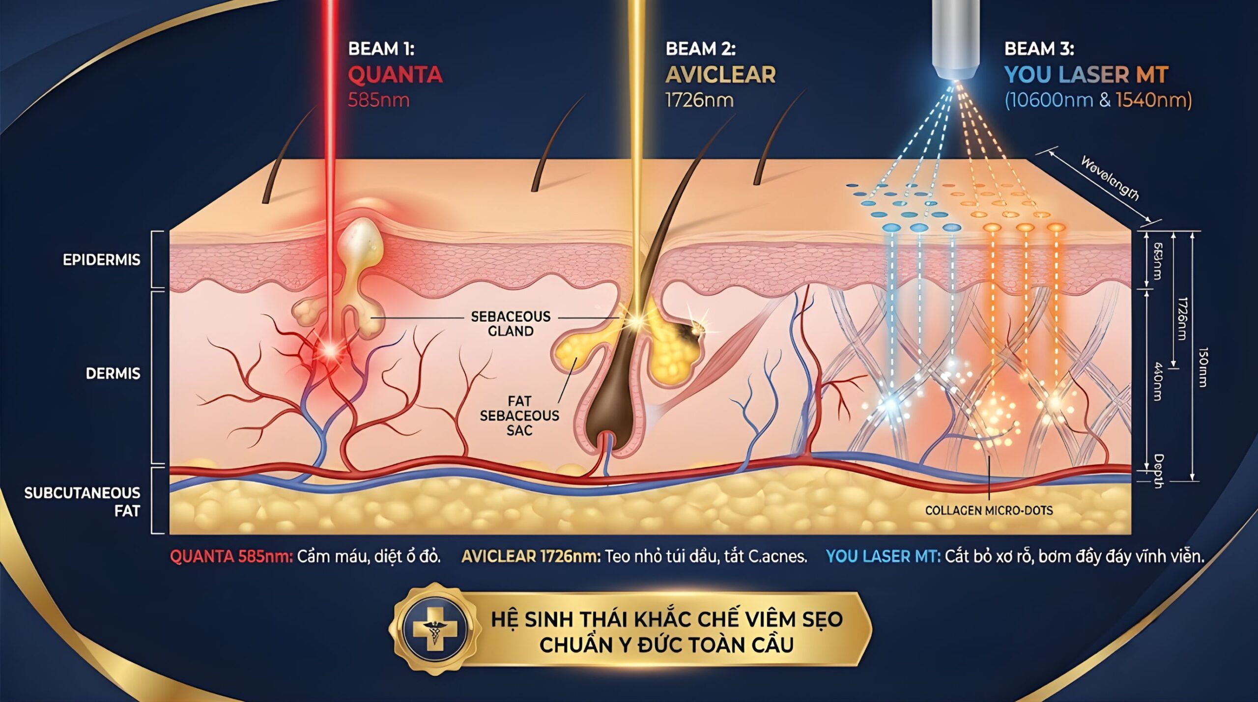 Phác đồ 3 công nghệ: Quanta 585 dập viêm cấp tốc, AviClear 1726nm kiểm soát tuyến bã nhờn từ gốc, You Laser MT tác động kép bóc tách và tăng sinh collagen làm rỗ