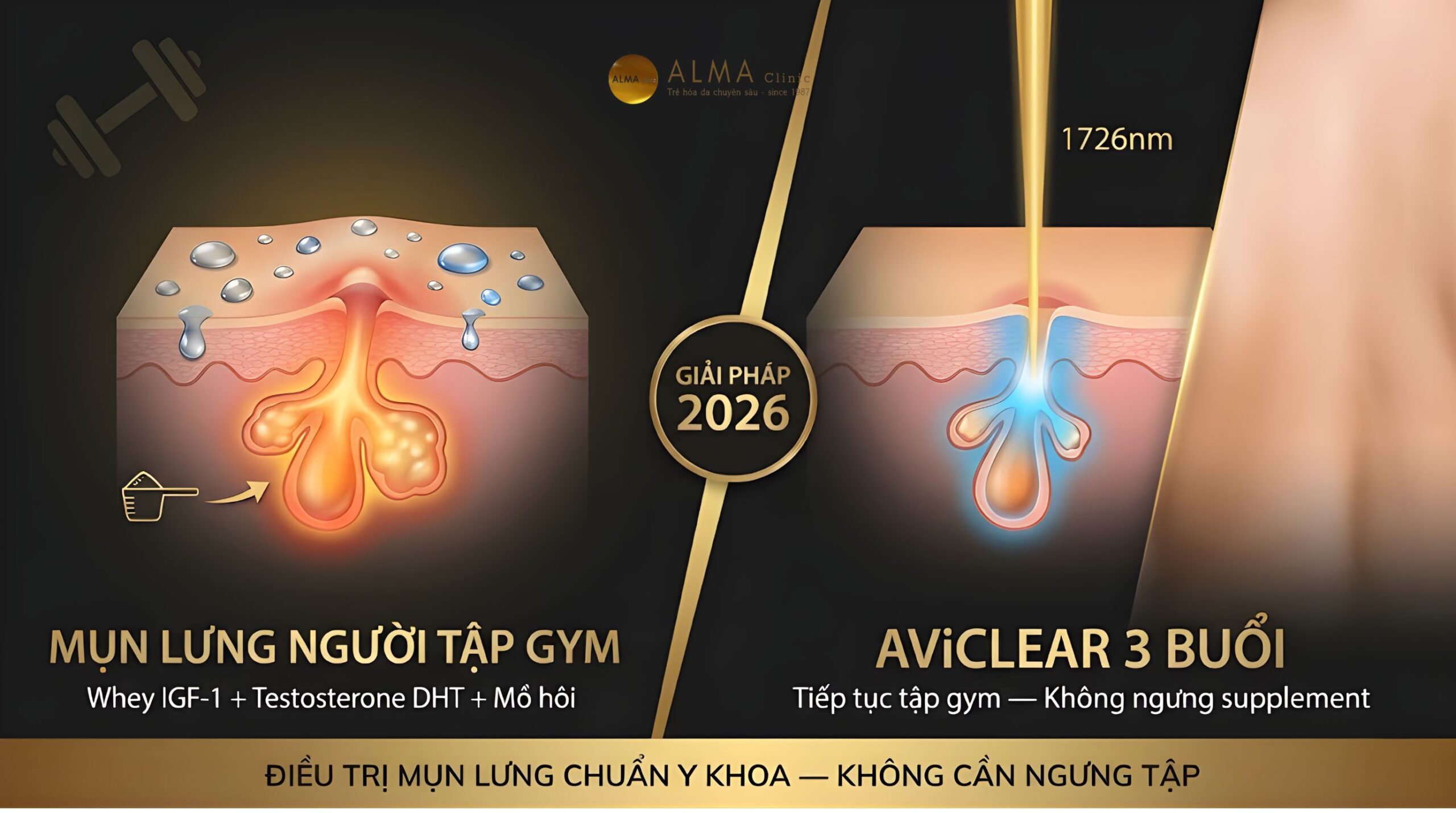 tri mun lung nguc nguoi tap gym aviclear alma scaled Mụn lưng và ngực ở người tập gym — nguyên nhân whey protein IGF-1, testosterone DHT, mồ hôi và ma sát, và giải pháp điều trị chuẩn y khoa AviClear không cần ngưng tập tại Alma Clinic