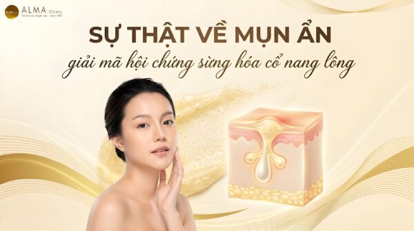 Mụn Ẩn Dưới Da Do Lớp Sừng Già: Nguyên Nhân & Giải Pháp