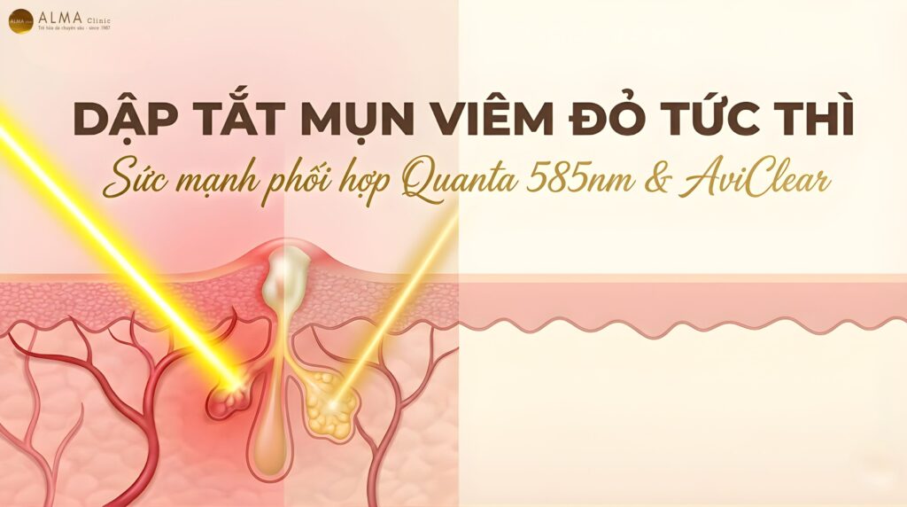 Tại Sao Cần Kết Hợp Quanta 585 (585nm) Ngay Khi Đang Bị Mụn Viêm Đỏ?