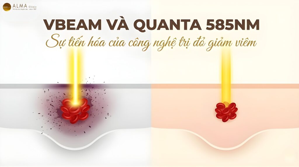 Sự Khác Biệt Giữa Laser Xung Nhuộm Màu (Vbeam) Và Quanta 585 Trong Trị Mụn?