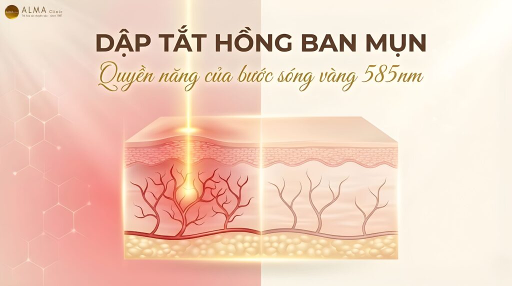 Tại Sao Việc Kiểm Soát Mạch Máu (Hemoglobin) Lại Giúp Giảm Đỏ Da Sau Mụn?