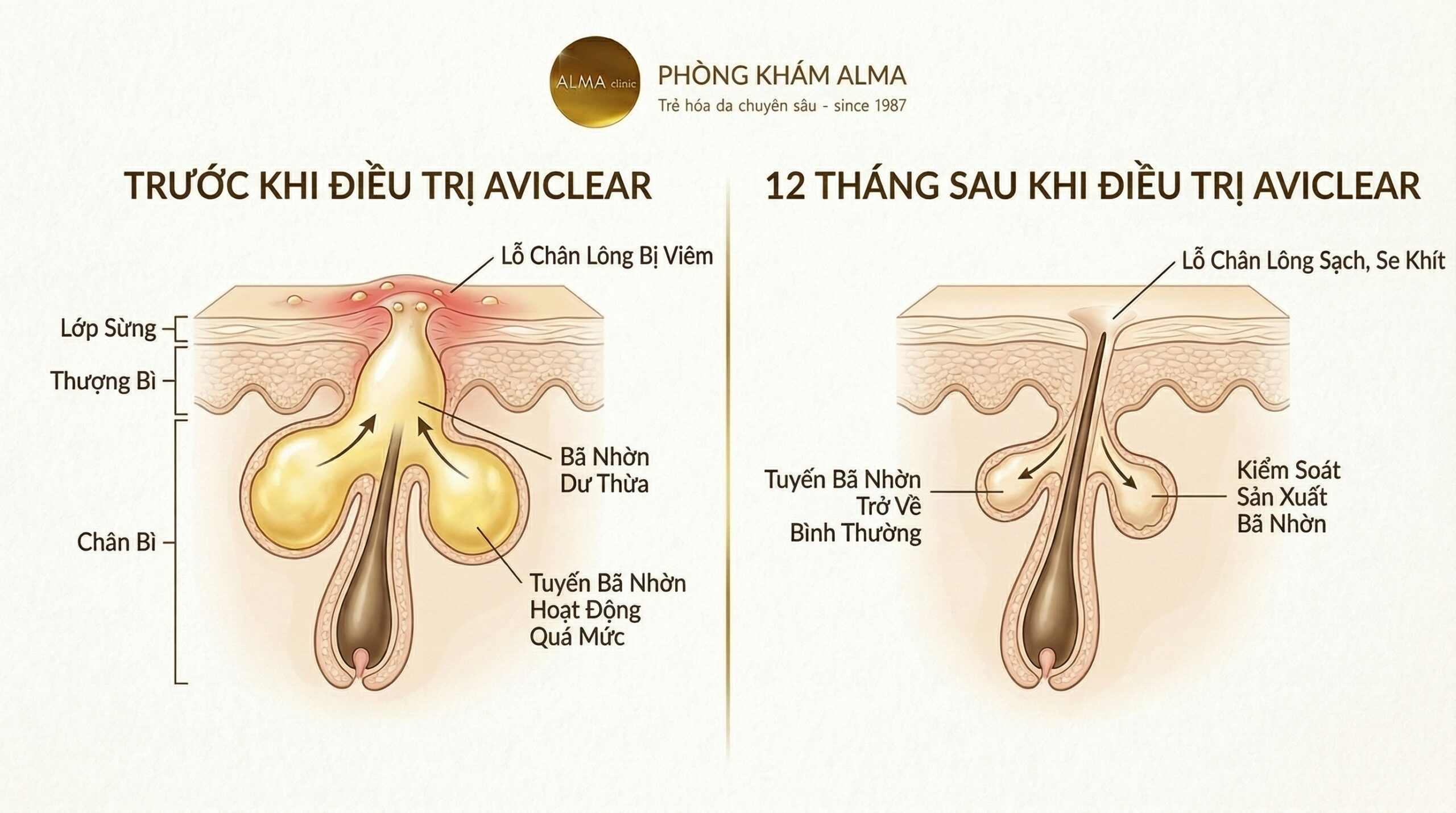 "TRƯỚC KHI ĐIỀU TRỊ": Tuyến bã nhờn phình to, căng phồng, màu vàng đậm, tiết dầu thừa tràn lên lỗ chân lông. Lỗ chân lông bên trên sưng đỏ, tắc nghẽn, viêm nhẹ.- Phía phải — nhãn: "SAU 12 THÁNG ĐIỀU TRỊ AVICLEAR": Tuyến bã nhờn teo nhỏ lại, kích thước bình thường, màu sắc nhạt dần. Lỗ chân lông bên trên se khít, sáng trong, sạch hoàn toàn, không viêm.