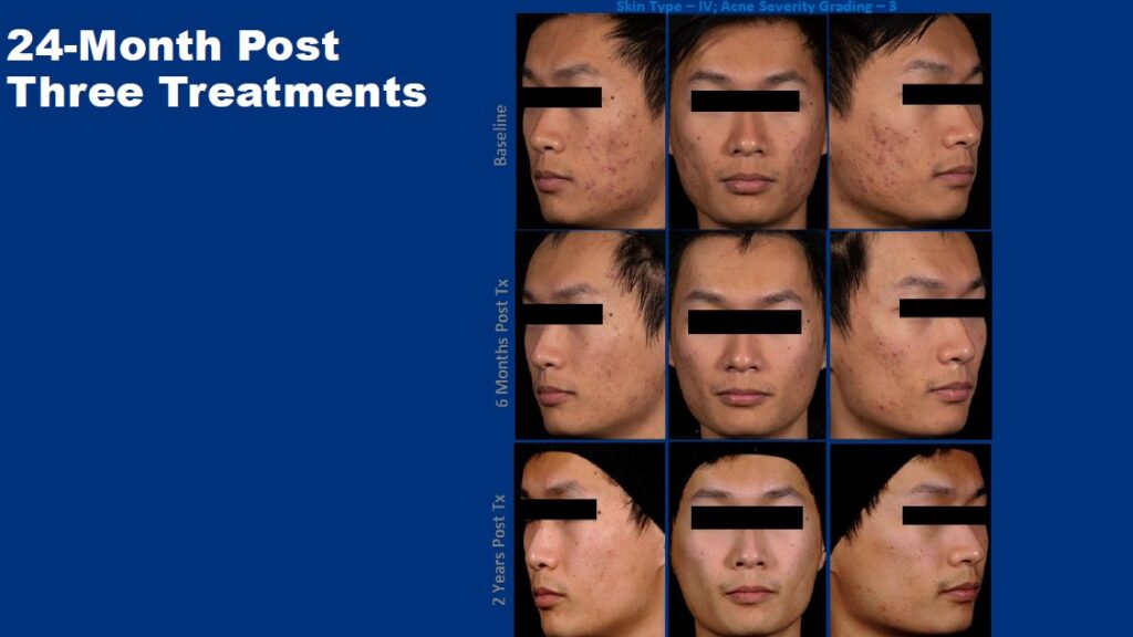 Phòng khám da liễu ALMA CLINIC ket qua lam sang 24 thang