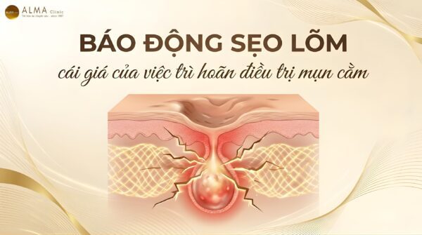 Báo Động: Mụn Cằm Nặng Là Lý Do Số 1 Gây Sẹo Lõm Rỗ Nặng