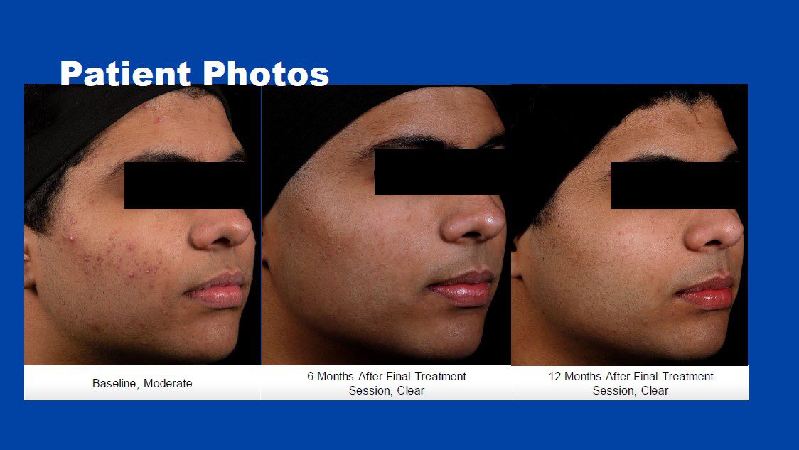 Phòng khám da liễu ALMA CLINIC patient 1 aviclear