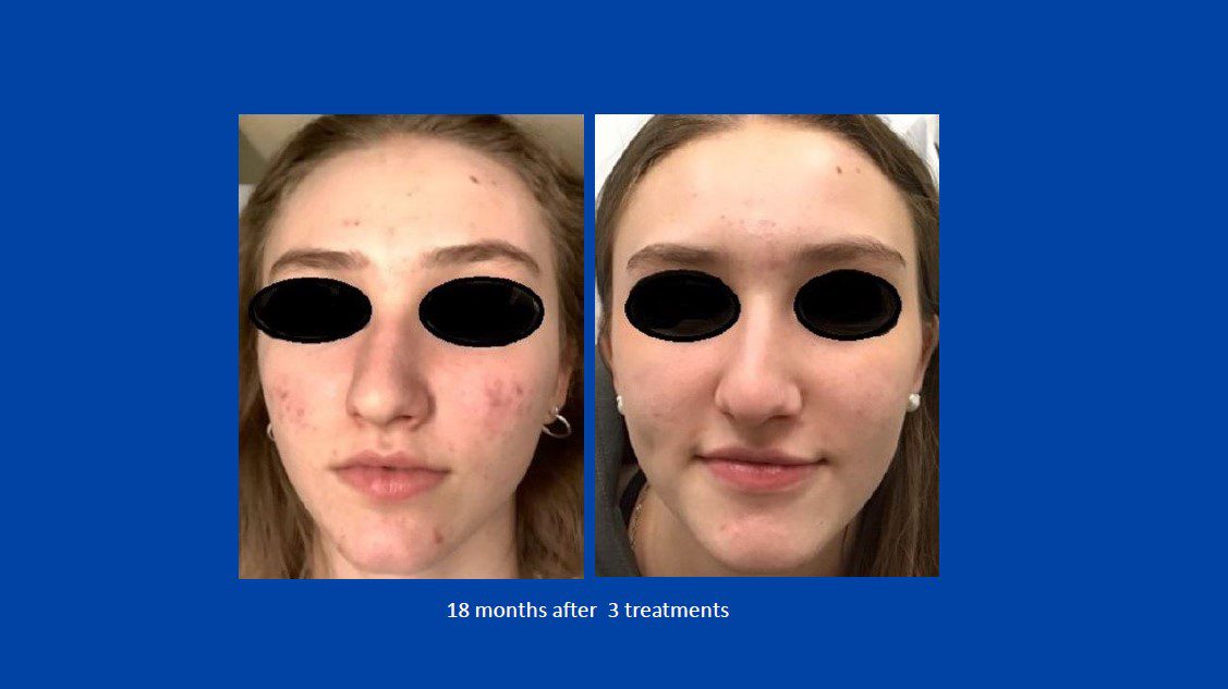 Phòng khám da liễu ALMA CLINIC patient 7 aviclear 18 thang sau 3 treatment