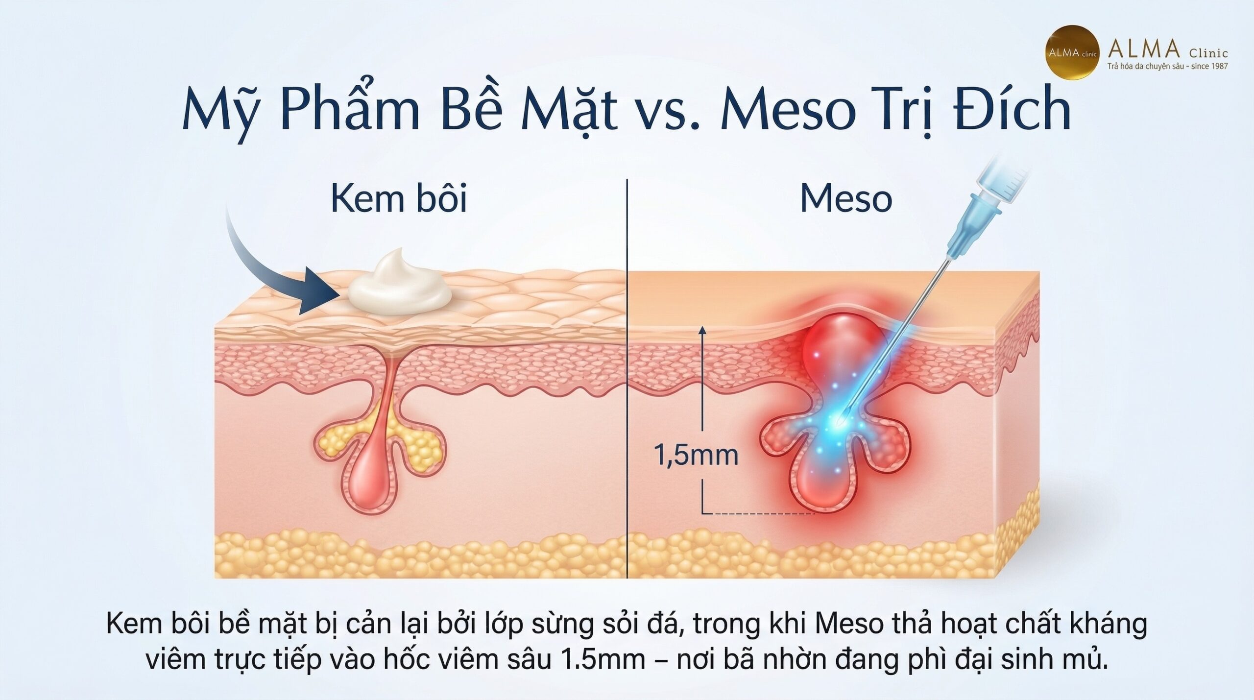 Infographic y khoa so sánh khả năng thẩm thấu của kem và serum bôi ngoài da với kỹ thuật tiêm Meso điều trị mụn