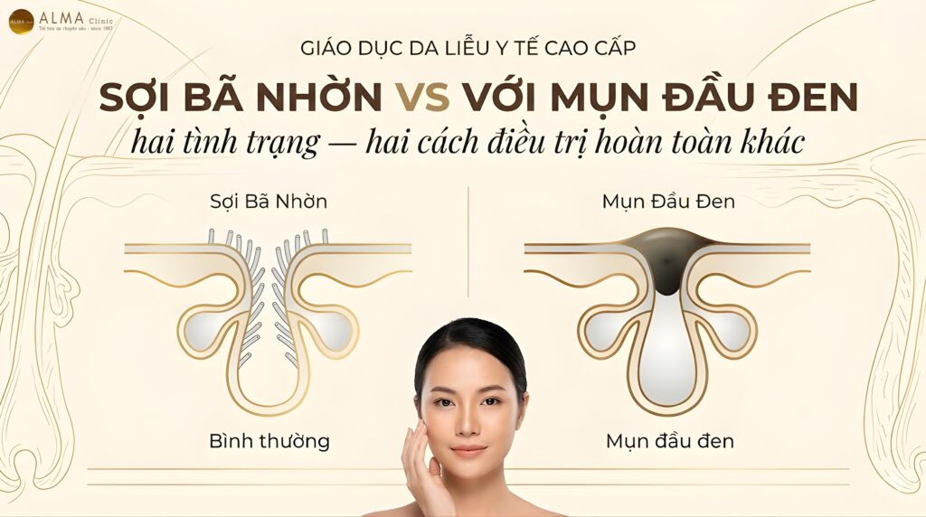 Sự Khác Biệt Giữa Sợi Bã Nhờn (Sebaceous Filaments) Và Mụn Đầu Đen Là Gì? [2026]