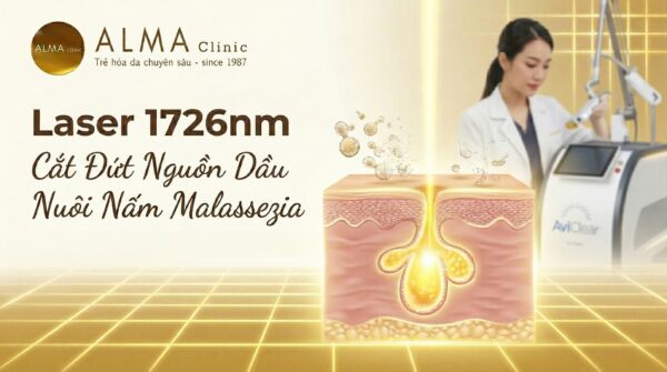 Minh họa cơ chế Laser 1726nm tác động vào tuyến bã nhờn trong da, cắt đứt nguồn dinh dưỡng của nấm Malassezia