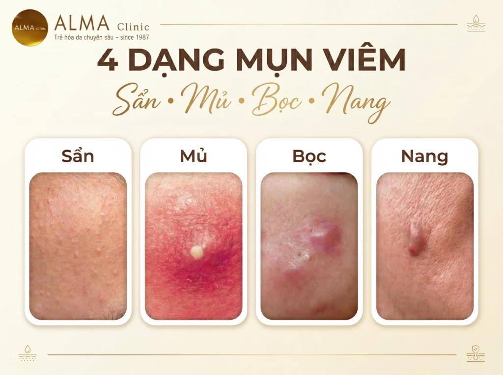Mụn viêm là gì và các loại mụn viêm thường gặp