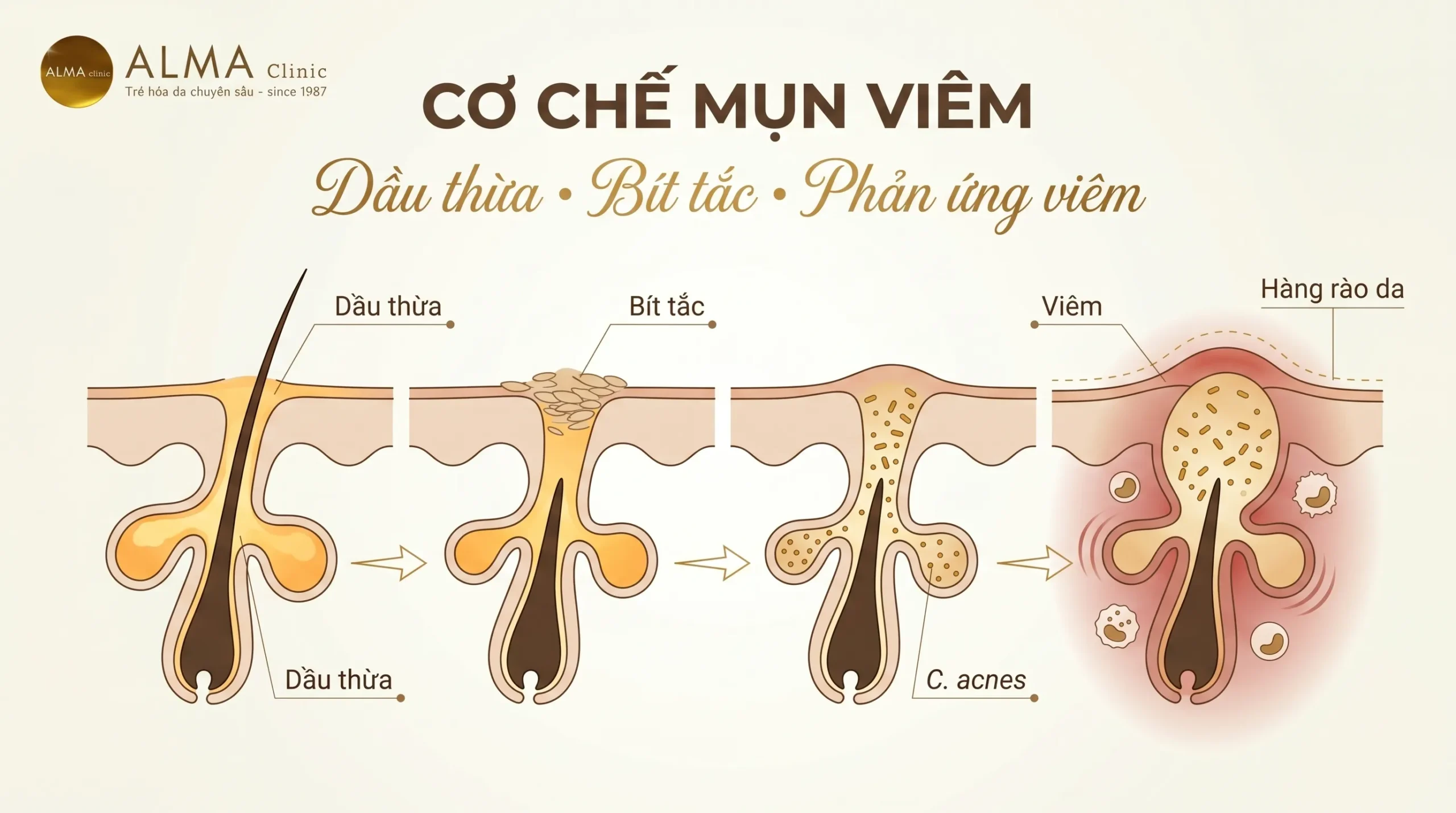 co che hinh thanh mun viem nang long tuyen ba scaled Sơ đồ cơ chế mụn viêm liên quan dầu thừa, bít tắc, C. acnes và phản ứng viêm