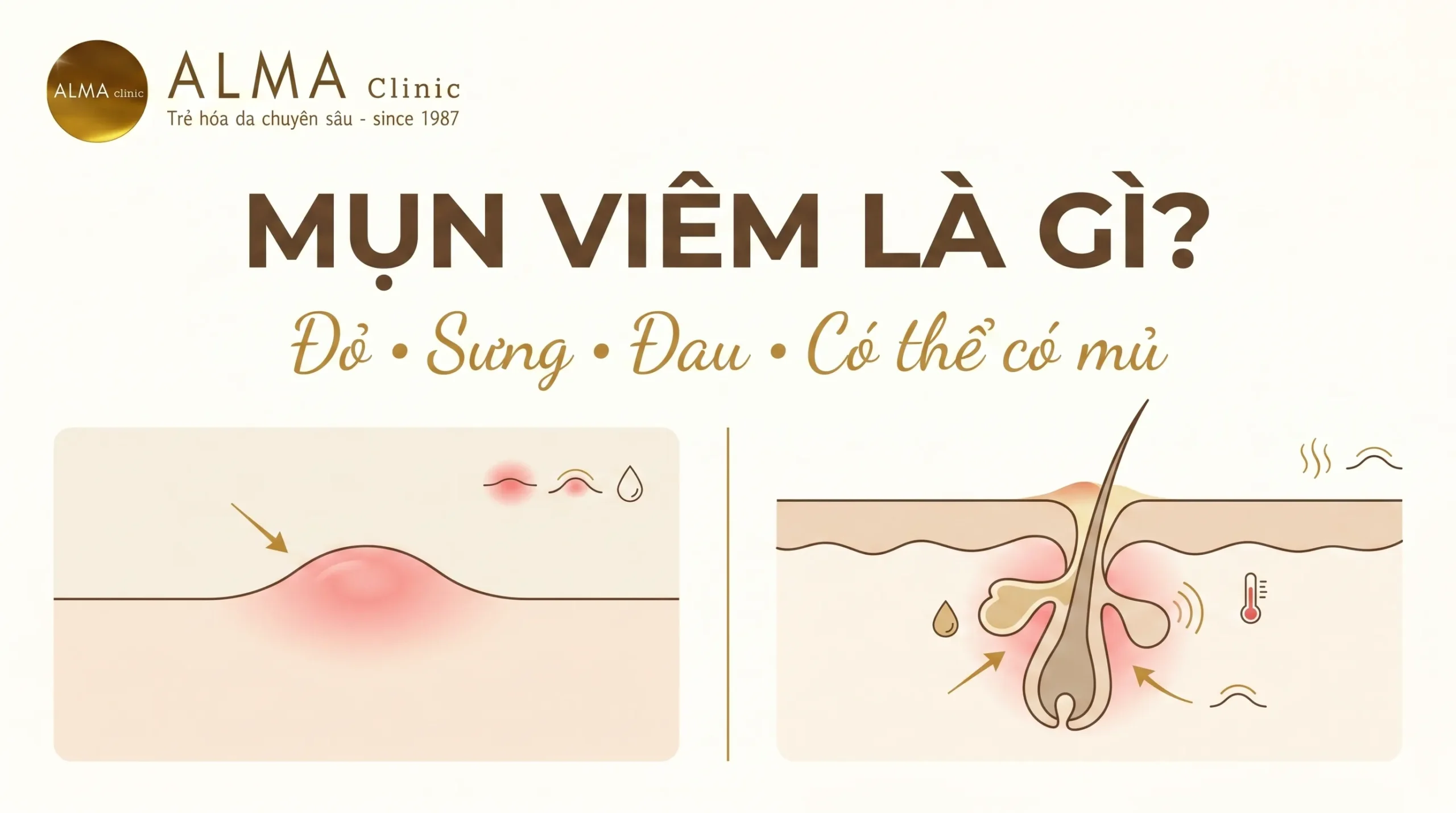 mun viem la gi dau hieu do sung dau scaled Minh họa mụn viêm là dạng mụn đỏ, sưng, đau hoặc có mủ