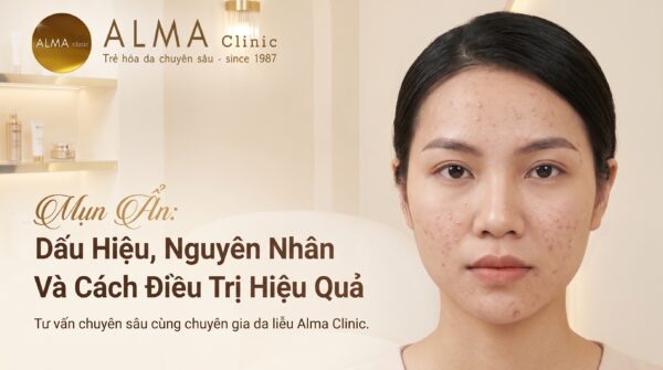 Bản đồ quyết định khi nào nên và không nên lấy nhân mụn chuẩn y khoa