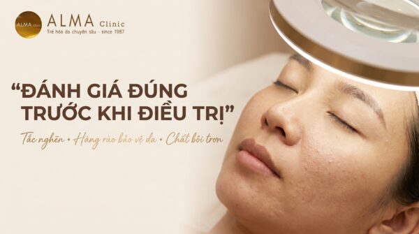 Minh họa lớp sừng dày giữ tế bào chết và bã nhờn làm lỗ chân lông bít tắc