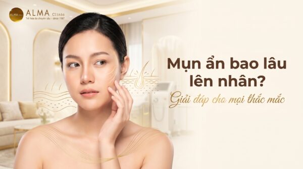Minh họa mụn ẩn dưới da không có mốc cố định để lên nhân