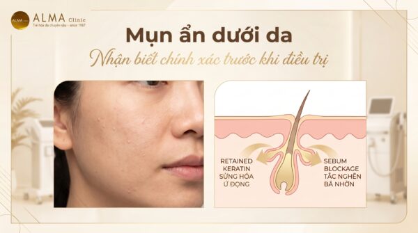 Minh họa mụn ẩn dưới da và cách xử trí an toàn