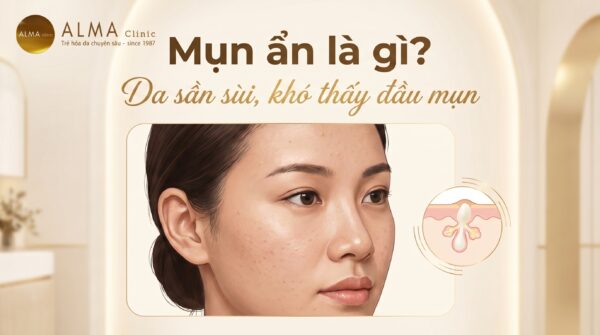 Mụn ẩn là gì và dấu hiệu da sần không thấy đầu mụn